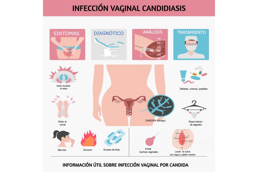 Candidiasis Vaginal. Respondemos a las preguntas más frecuentes