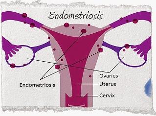 La endometriosis y su impacto en las mujeres