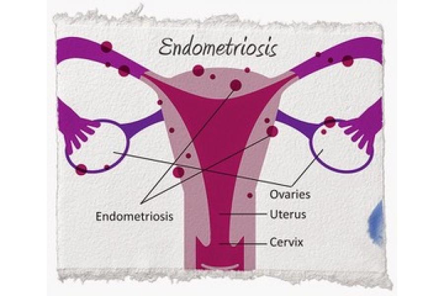 Endometriosis: síntomas, diagnóstico y tratamiento