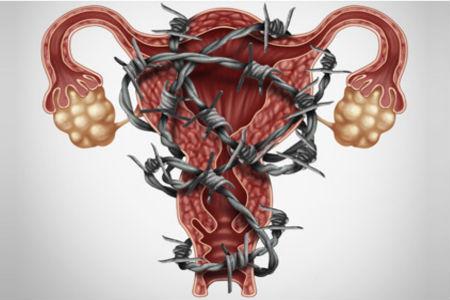 Aclarando mitos e ideas erróneas sobre la endometriosis