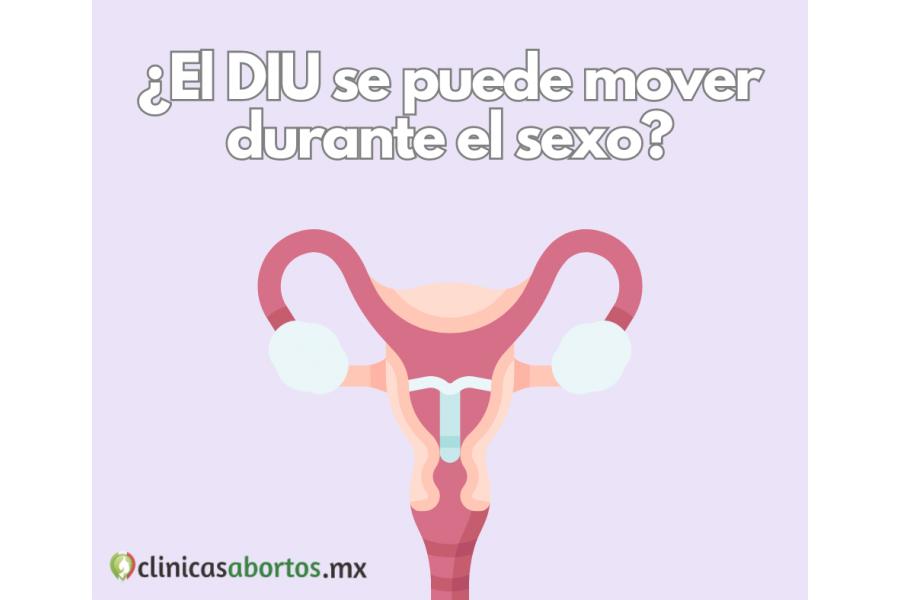 ¿El DIU se puede mover con el sexo?