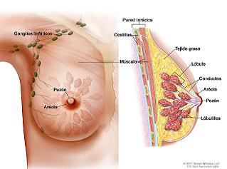 Cáncer de mama, alta prevalencia en mujeres