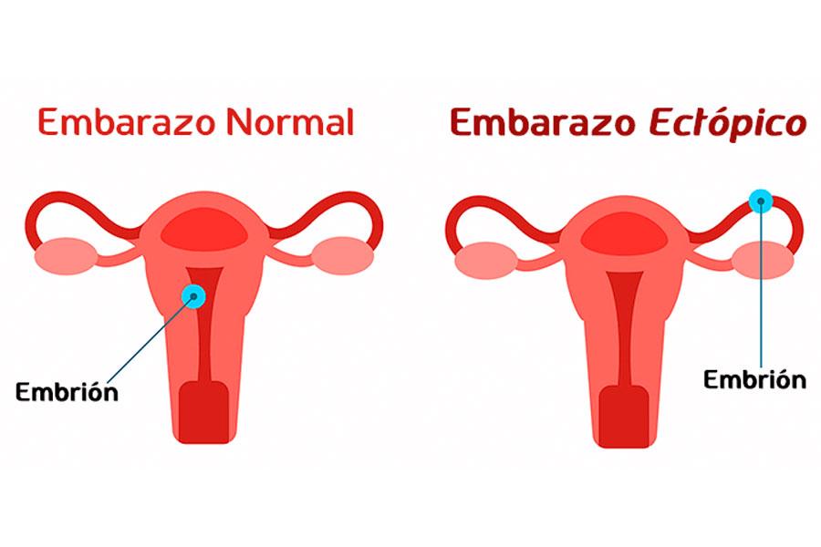 Una prueba de embarazo detecta un embarazo ectopico outlet